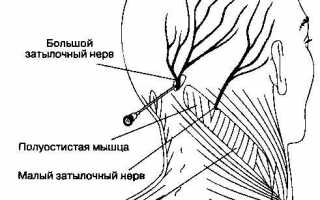 Блокада затылочного нерва при кластерной головной боли