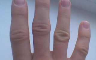 Опух сустав на пальце руки: что делать и как снять опухоль — Травмы и проблемы, Опухоли и отеки