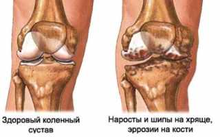 Краевые остеофиты коленного сустава: что это такое, диагностика и лечение