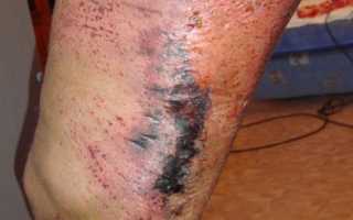 Лечение гематомы коленного сустава