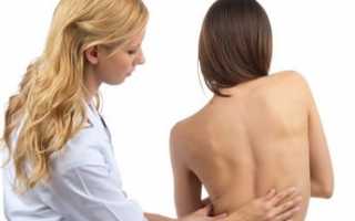 Сколиоз грудного отдела позвоночника симптомы и лечение