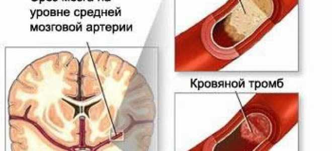 Ишемия головного мозга симптомы у взрослых