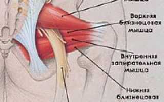 Воспаление грушевидной мышцы симптомы и лечение