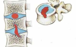 Грыжи шморля в грудном отделе позвоночника