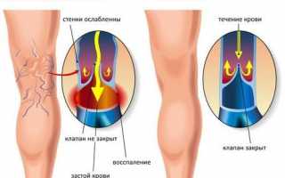 Что делать если чешутся и зудят ноги выше колена с внутренней стороны причины диагностика и лечение