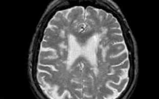 Лейкоареоз головного мозга: что это такое