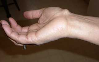 Доброкачественное новообразование или синовиальная киста на руке