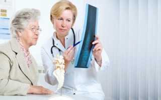 Ревматоидный артрит — симптомы и признаки, лечение, первые признаки у женщин
