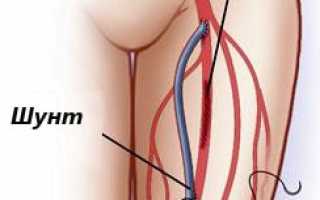 Шунтирование бедренной артерии: показания и противопоказания, ход операции и реабилитация