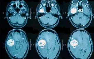 Рак мозга симптомы первые признаки у мужчин