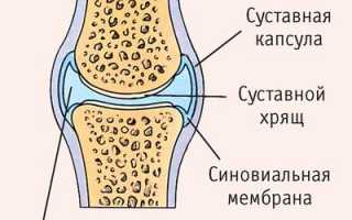 Что такое бурсит и синовит колена отличия воспалений и методы лечения