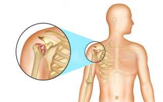 Полиартрит плечевого сустава: симптомы и лечение народными средствами, причины и массаж