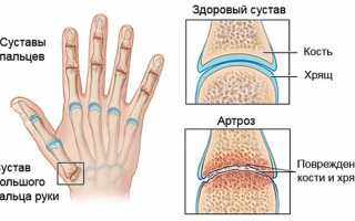Лекарства при артрозе кистей рук