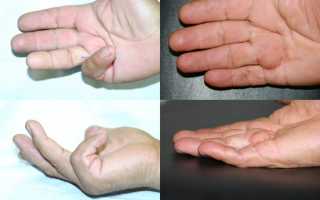 Почему больно сжать пальцы в кулак. Не сгибаются пальцы рук в кулак лечение народными средствами
