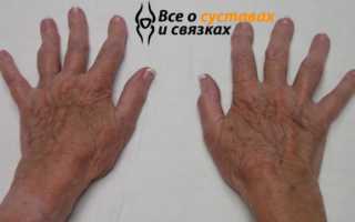 Артроз пальцев рук симптомы и лечение