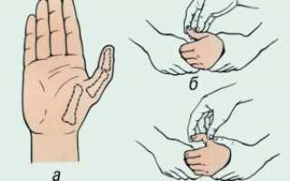 Вывих пальца на руке — что делать, симптомы, диагностика, лечение