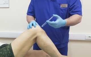 Бурсит коленного сустава лечение в домашних условиях