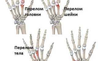 Перелом 2 пястной кости
