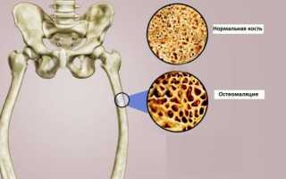 Остеомаляция: что это такое, симптомы размягчения костей у взрослых и детей