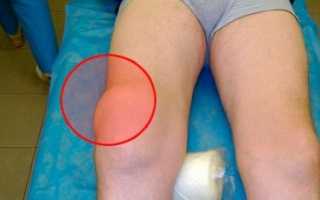 Что такое мениска коленного сустава