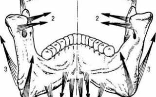 Перелом мыщелкового отростка нижней челюсти