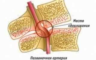 Шейный остеохондроз и артериальное давление