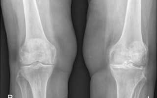 Остеоартроз коленного сустава 1, 2 и 3 степени: лечение, симптомы, что это такое?