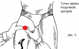 Пальцевое прижатие артерий при кровотечениях: таблица, алгоритм, схема, ориентиры, точки